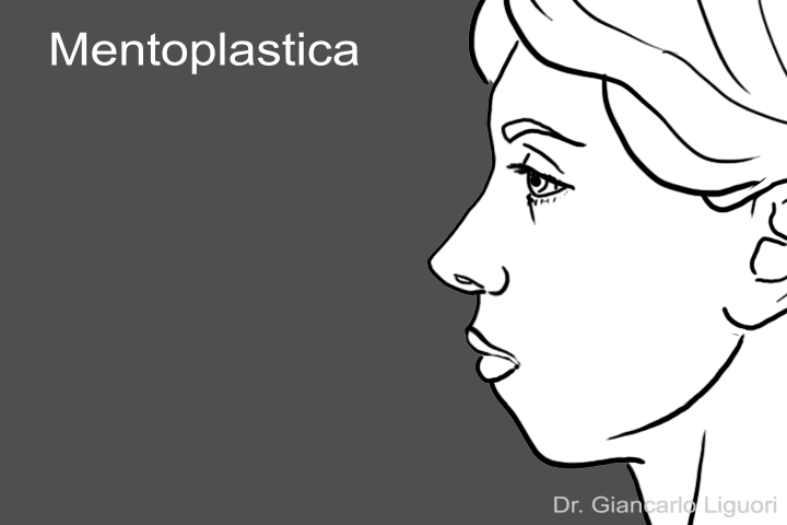 Dottor Giancarlo Liguori - Chirurgo Plastico a Torino - Chirurgia Plastica - Mentoplastica